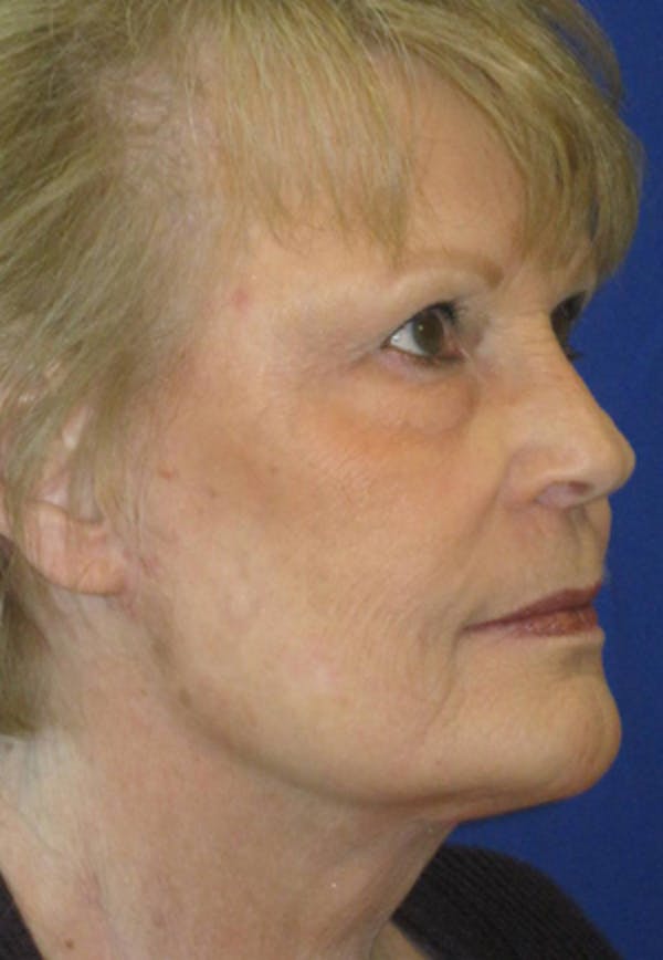 Facelift/Mini-Facelift Before & After Gallery - Patient 4890662 - Image 4