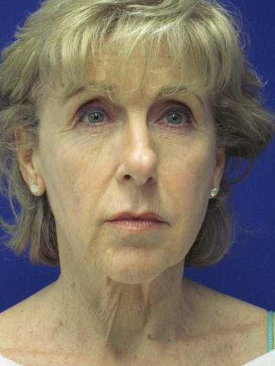 Facelift/Mini-Facelift Before & After Gallery - Patient 4890673 - Image 1