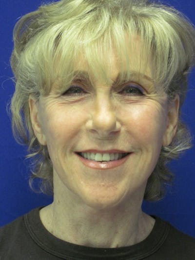 Facelift/Mini-Facelift Before & After Gallery - Patient 4890673 - Image 2