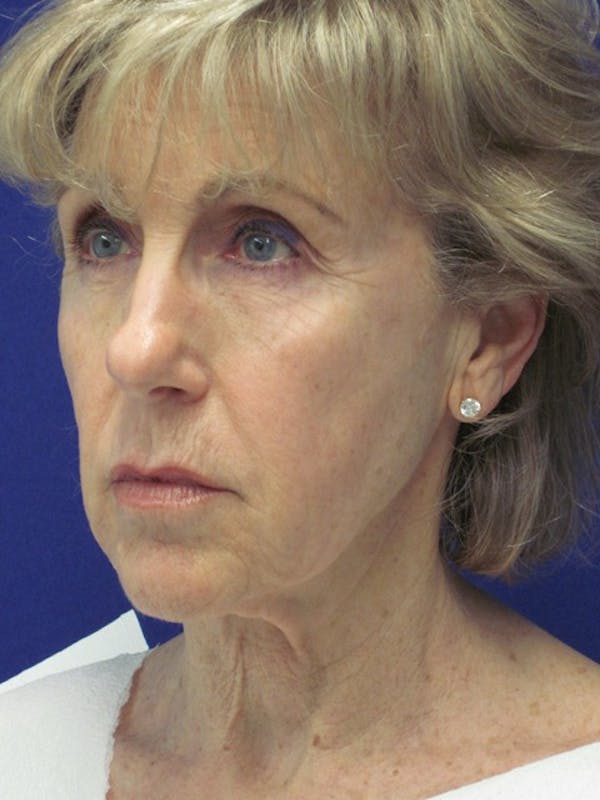 Facelift/Mini-Facelift Before & After Gallery - Patient 4890673 - Image 3
