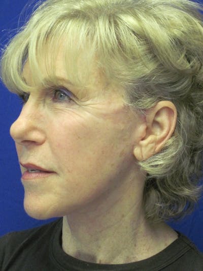 Facelift/Mini-Facelift Before & After Gallery - Patient 4890673 - Image 4