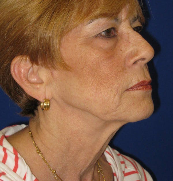 Facelift/Mini-Facelift Before & After Gallery - Patient 4890703 - Image 3