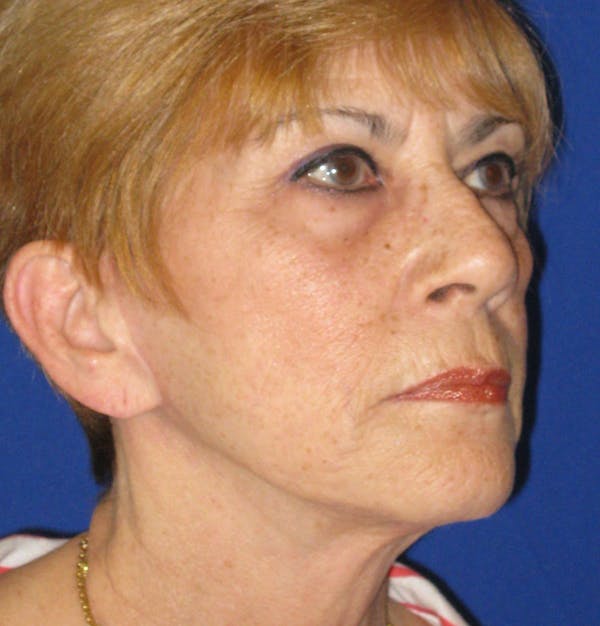 Facelift/Mini-Facelift Before & After Gallery - Patient 4890703 - Image 4