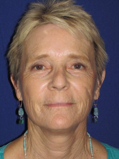 Facelift/Mini-Facelift Before & After Gallery - Patient 4890705 - Image 2