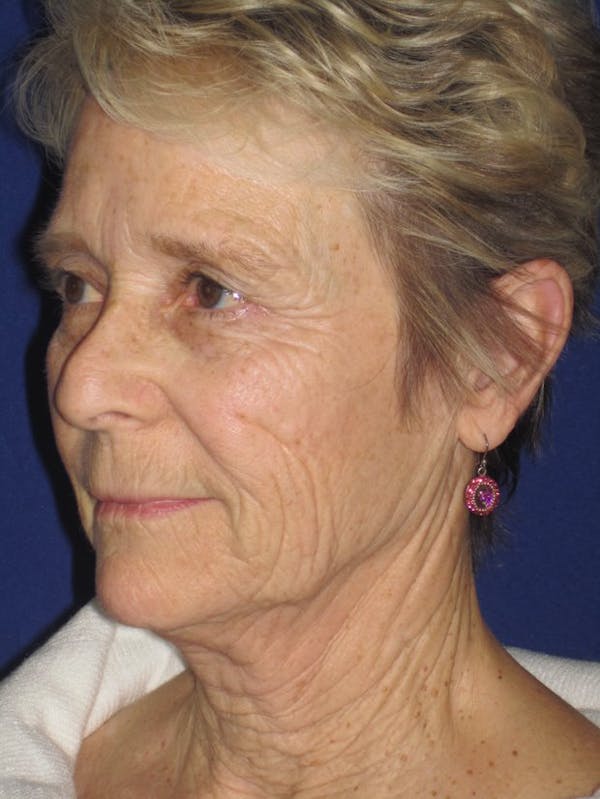 Facelift/Mini-Facelift Before & After Gallery - Patient 4890705 - Image 3