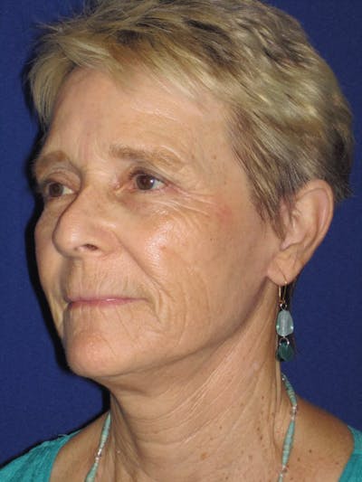 Facelift/Mini-Facelift Before & After Gallery - Patient 4890705 - Image 4