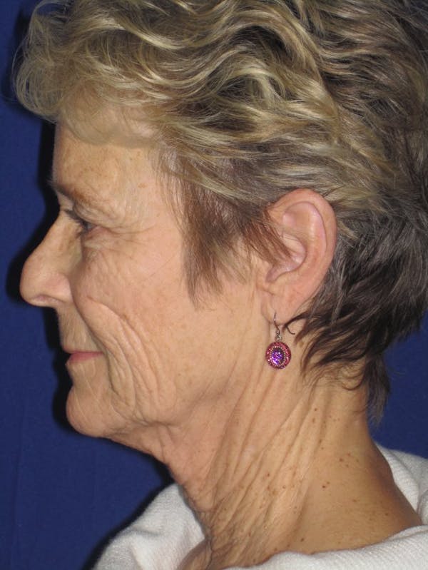 Facelift/Mini-Facelift Before & After Gallery - Patient 4890705 - Image 5