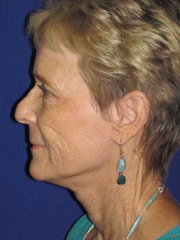 Facelift/Mini-Facelift Before & After Gallery - Patient 4890705 - Image 6