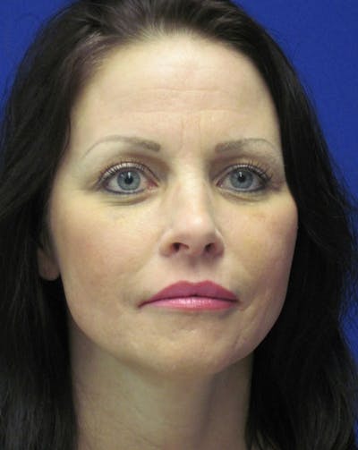 Fat Grafting Before & After Gallery - Patient 4890744 - Image 2