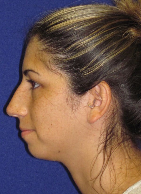 Rhinoplasty Before & After Gallery - Patient 4890749 - Image 1