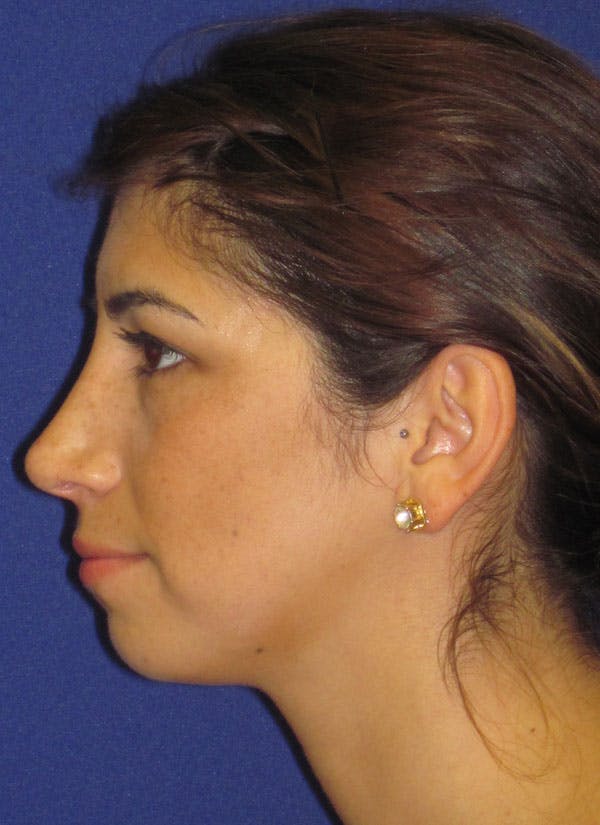 Rhinoplasty Before & After Gallery - Patient 4890749 - Image 2