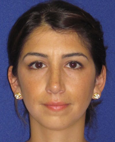 Rhinoplasty Before & After Gallery - Patient 4890749 - Image 4