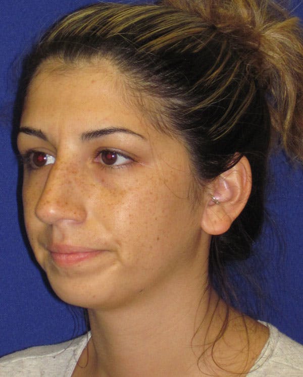 Rhinoplasty Before & After Gallery - Patient 4890749 - Image 5