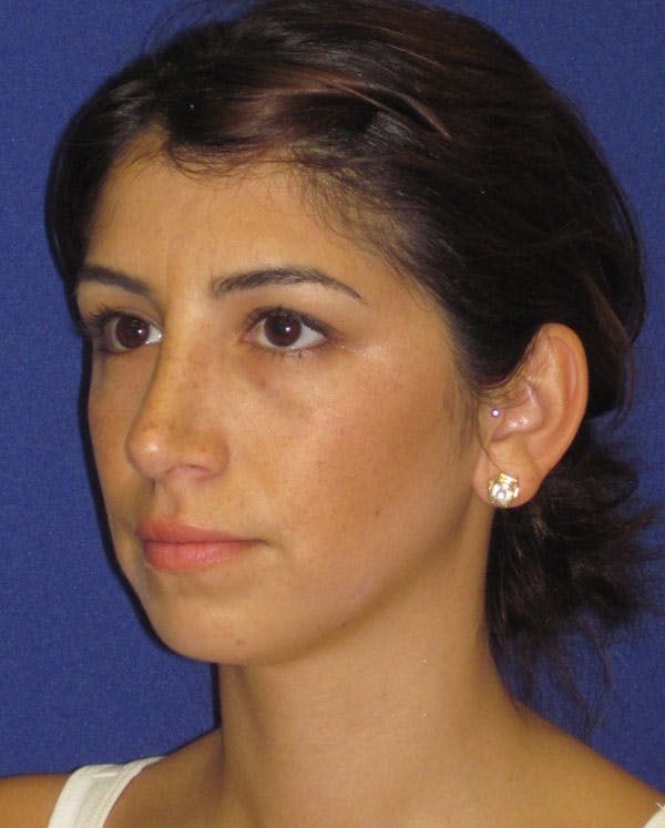 Rhinoplasty Before & After Gallery - Patient 4890749 - Image 6