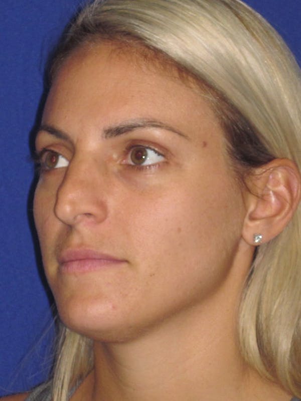 Rhinoplasty Before & After Gallery - Patient 4890752 - Image 3