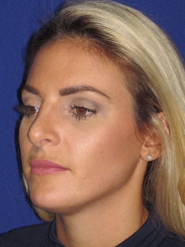 Rhinoplasty Before & After Gallery - Patient 4890752 - Image 4