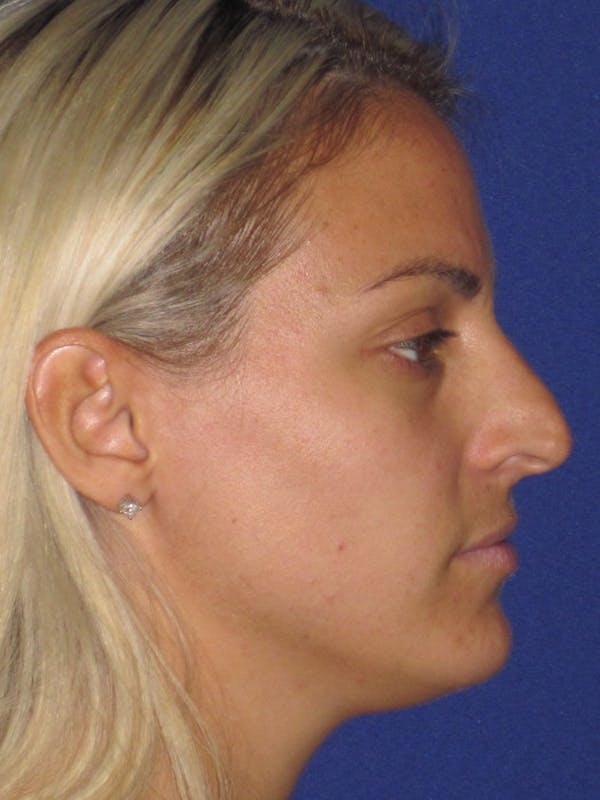 Rhinoplasty Before & After Gallery - Patient 4890752 - Image 5