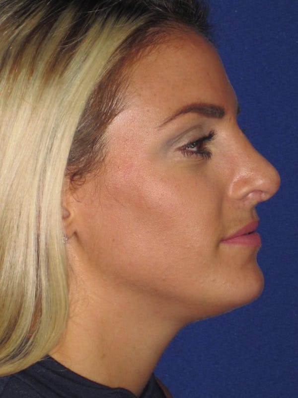 Rhinoplasty Before & After Gallery - Patient 4890752 - Image 6