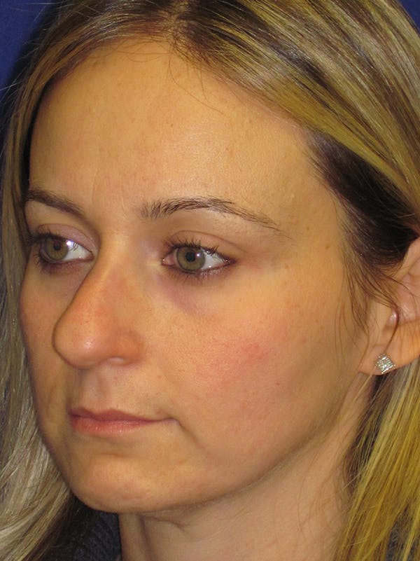 Rhinoplasty Before & After Gallery - Patient 4890782 - Image 1