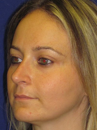 Rhinoplasty Before & After Gallery - Patient 4890782 - Image 2