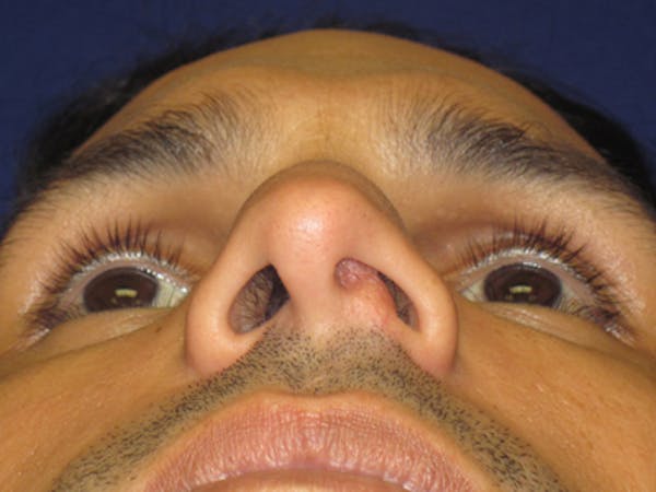 Septoplasty Before & After Gallery - Patient 4890776 - Image 1