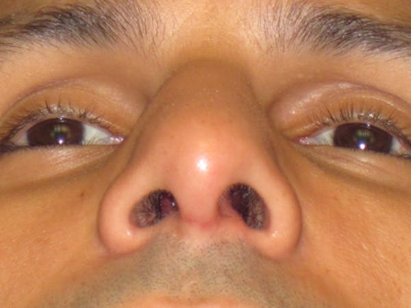 Septoplasty Before & After Gallery - Patient 4890776 - Image 2