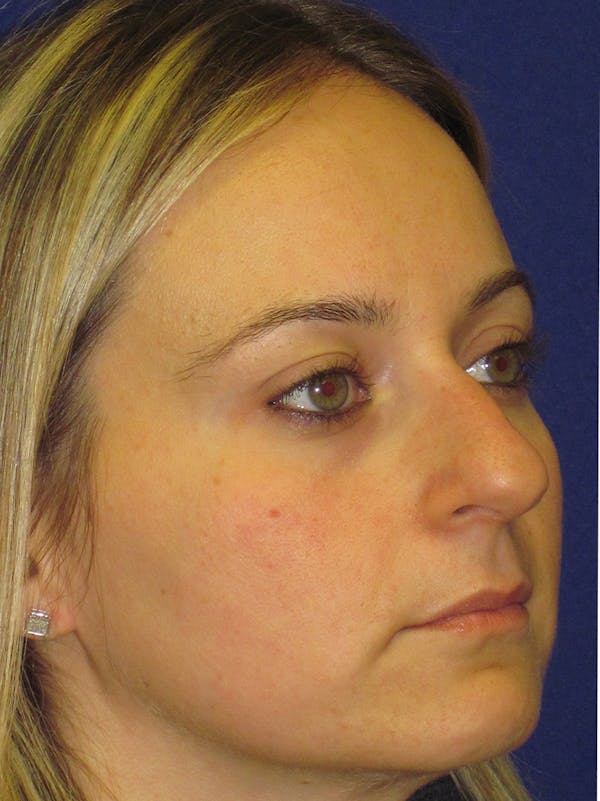 Rhinoplasty Before & After Gallery - Patient 4890782 - Image 3