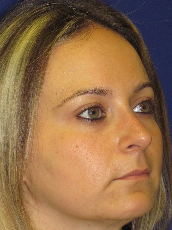 Rhinoplasty Before & After Gallery - Patient 4890782 - Image 4