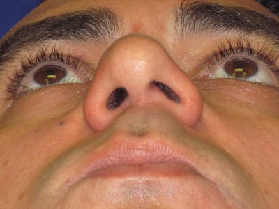 Septoplasty Before & After Gallery - Patient 4890779 - Image 1