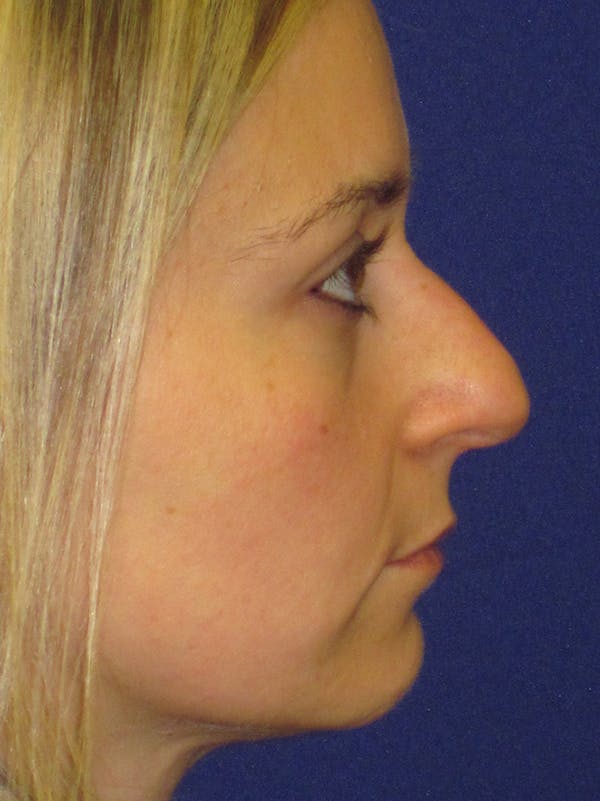 Rhinoplasty Before & After Gallery - Patient 4890782 - Image 5