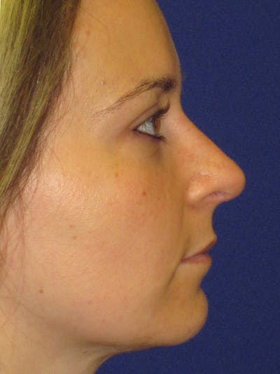 Rhinoplasty Before & After Gallery - Patient 4890782 - Image 6