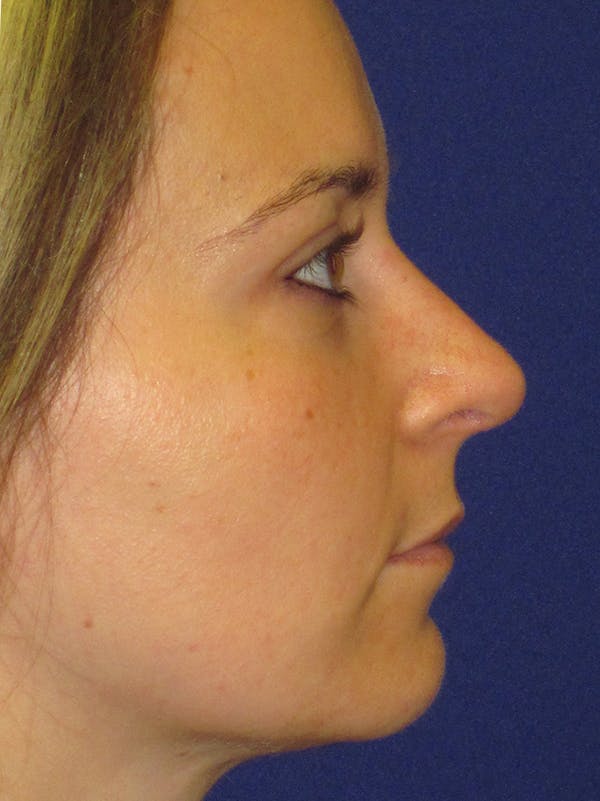 Rhinoplasty Before & After Gallery - Patient 4890782 - Image 6