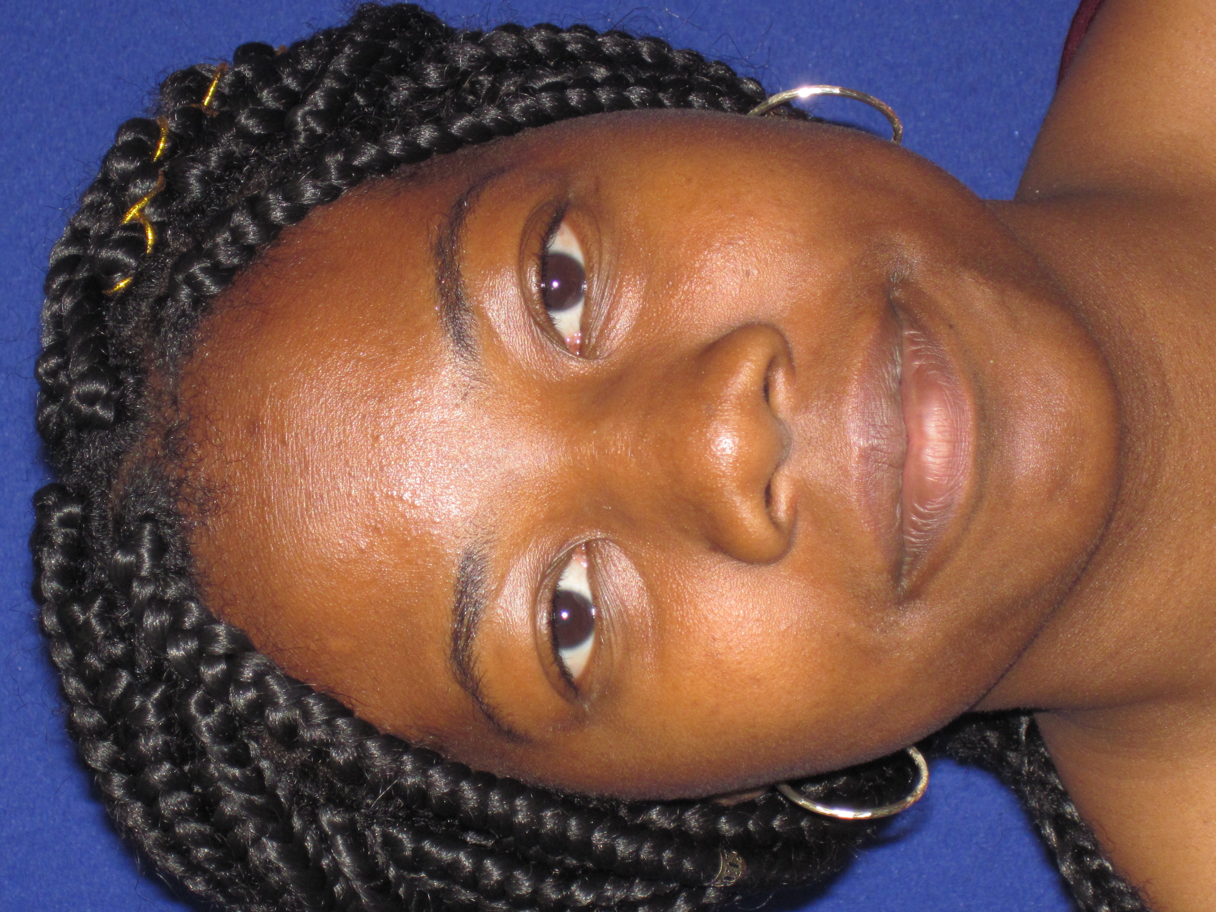 Before Rhinoplasty