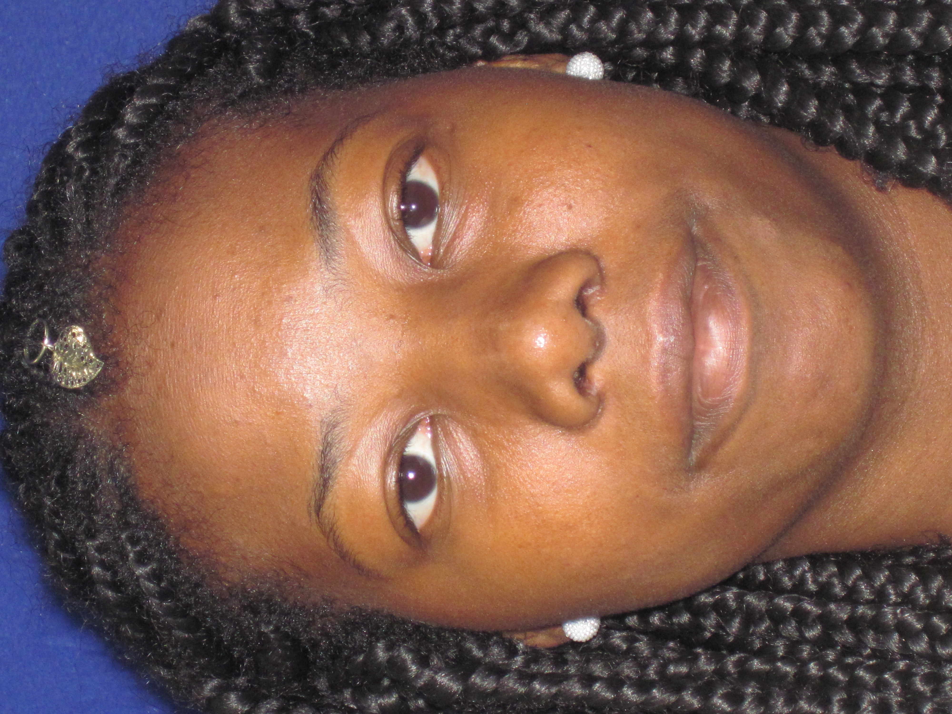 After Rhinoplasty