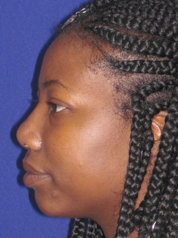Rhinoplasty Before & After Gallery - Patient 4890805 - Image 4