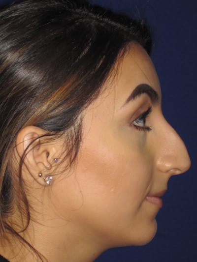 Rhinoplasty Before & After Gallery - Patient 4890855 - Image 1
