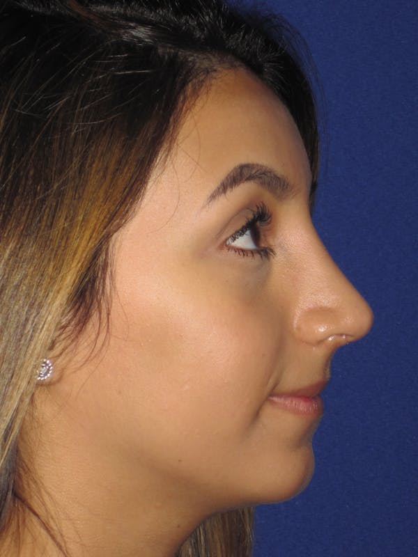 Rhinoplasty Before & After Gallery - Patient 4890855 - Image 2