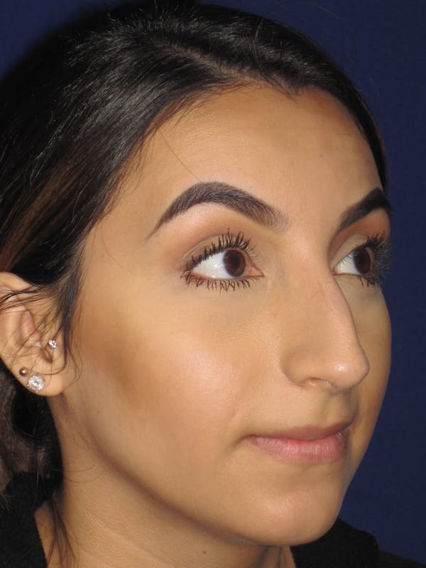 Rhinoplasty Before & After Gallery - Patient 4890855 - Image 3