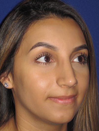 Rhinoplasty Before & After Gallery - Patient 4890855 - Image 4