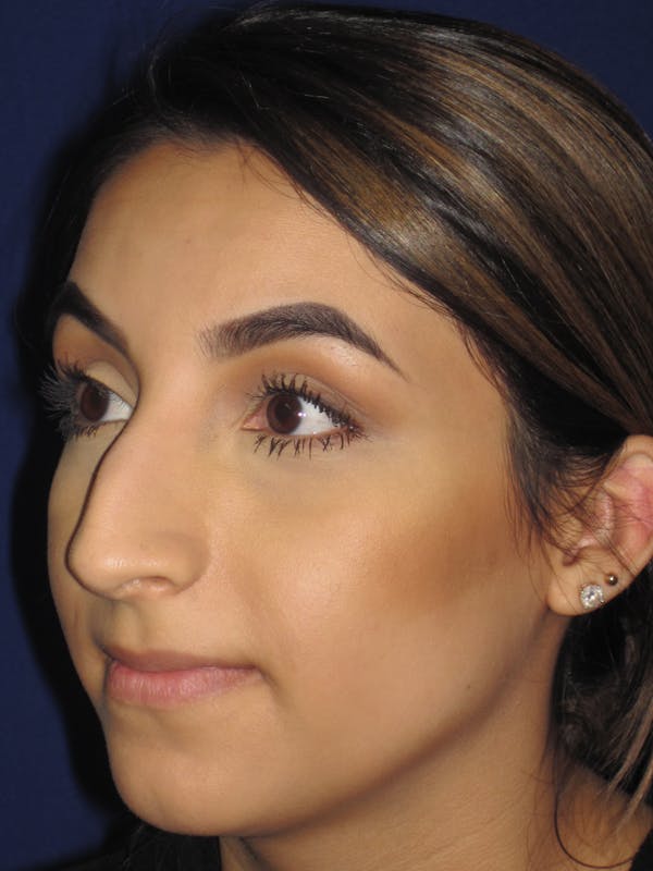 Rhinoplasty Before & After Gallery - Patient 4890855 - Image 5