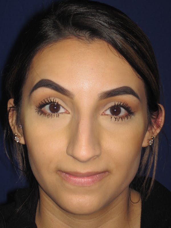 Rhinoplasty Before & After Gallery - Patient 4890855 - Image 7