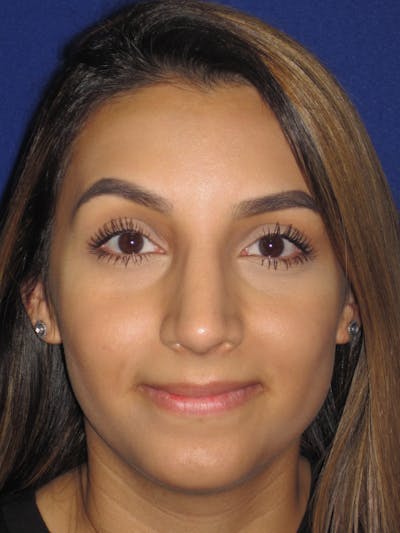 Rhinoplasty Before & After Gallery - Patient 4890855 - Image 8