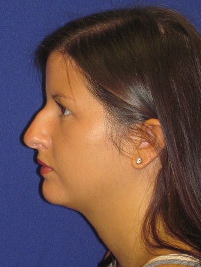 Rhinoplasty Before & After Gallery - Patient 4890859 - Image 1