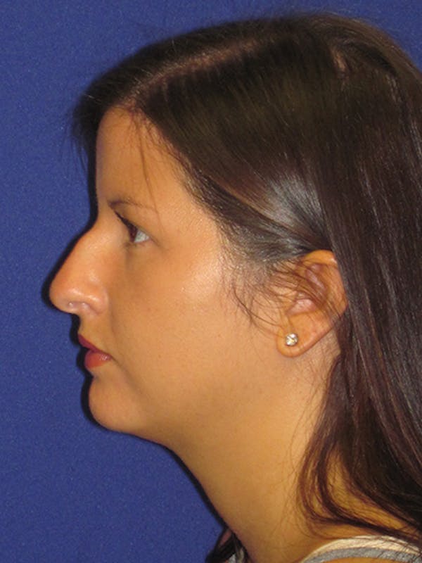 Rhinoplasty Before & After Gallery - Patient 4890859 - Image 1