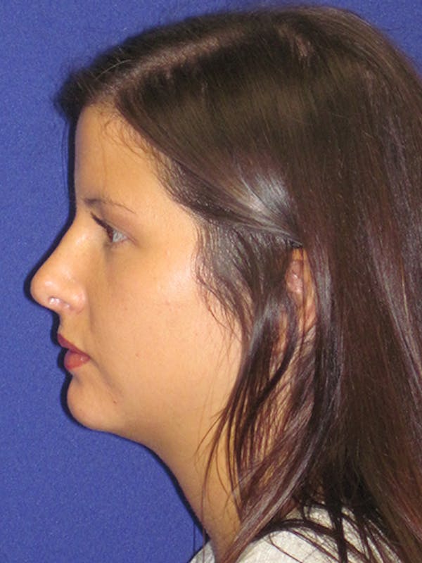 Rhinoplasty Before & After Gallery - Patient 4890859 - Image 2