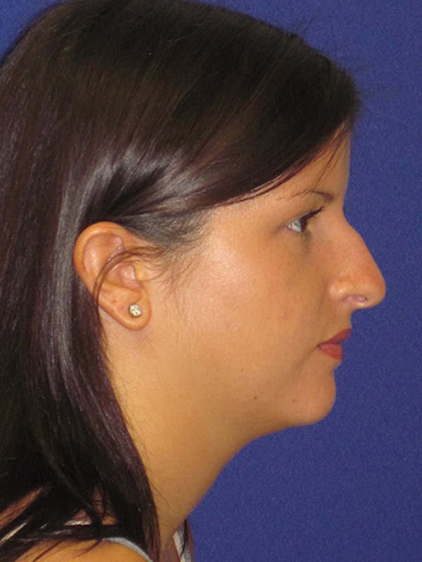 Rhinoplasty Before & After Gallery - Patient 4890859 - Image 3