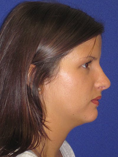 Rhinoplasty Before & After Gallery - Patient 4890859 - Image 4