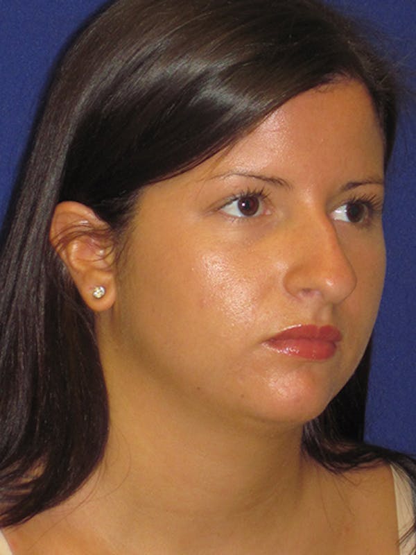 Rhinoplasty Before & After Gallery - Patient 4890859 - Image 5