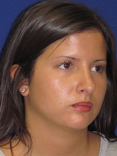 Rhinoplasty Before & After Gallery - Patient 4890859 - Image 6