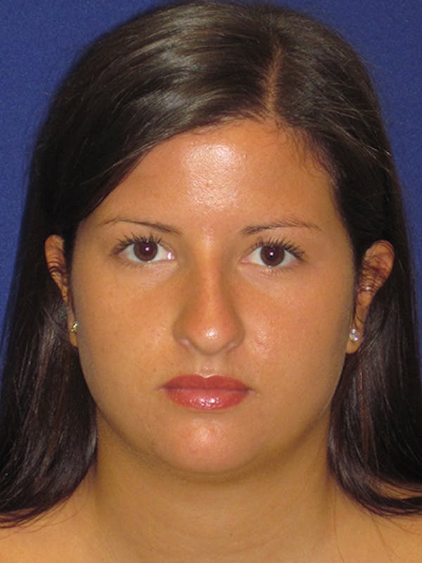 Rhinoplasty Before & After Gallery - Patient 4890859 - Image 7